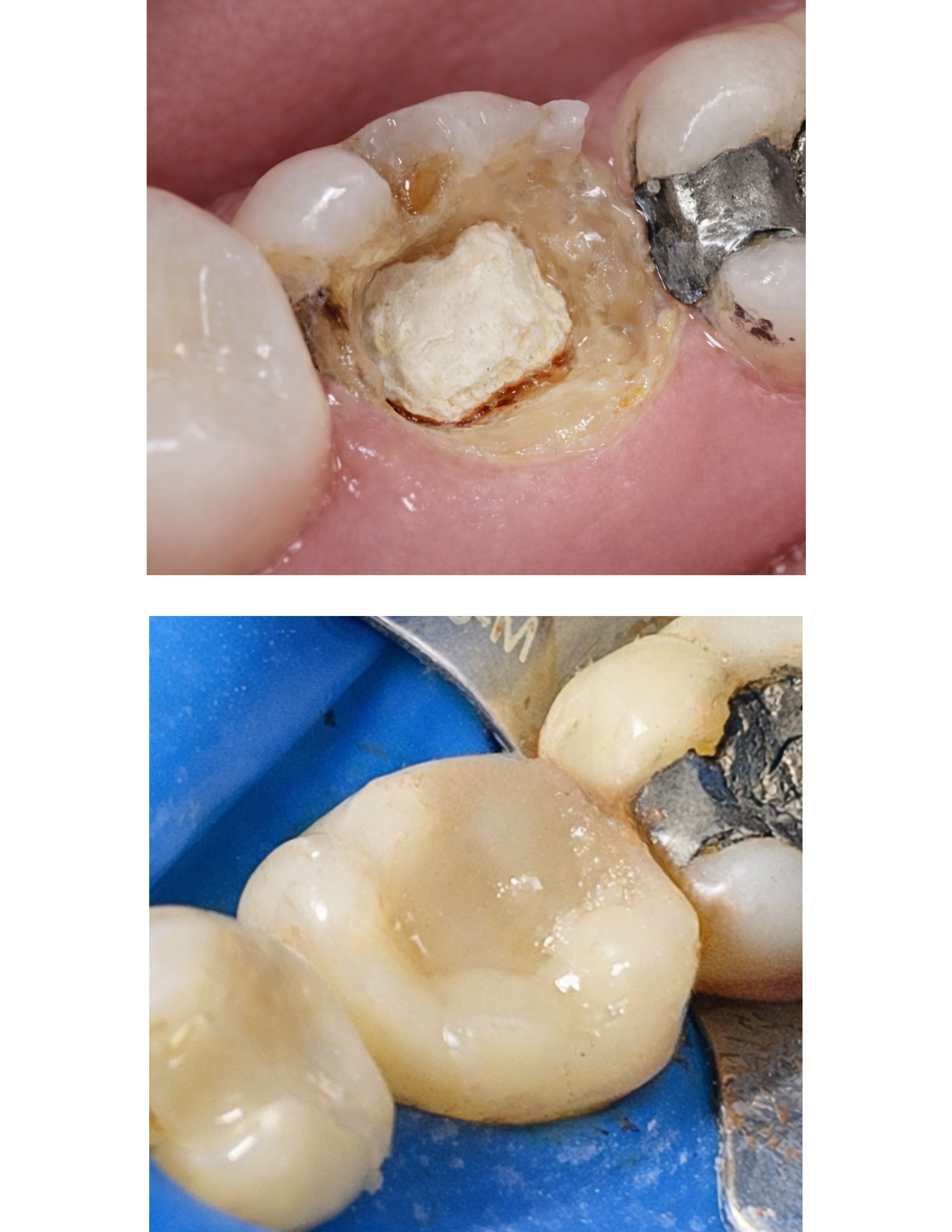 Restauração dental — tratamento odontológico VILARI, Taubaté